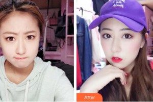 中南大學(xué)湘雅三醫(yī)院燒傷整形外科朱頡整形價格表附微針水光案例展示