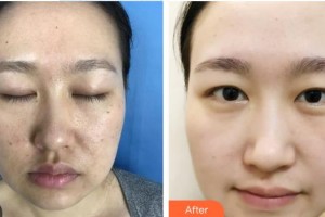 中南大學(xué)湘雅三醫(yī)院燒傷整形外科彭浩整形價格表附微針水光案例展示