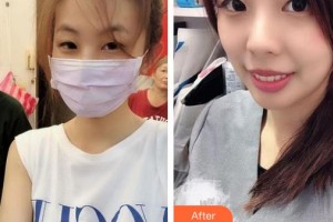 中南大學(xué)湘雅三醫(yī)院燒傷整形外科周建大整形價格表附皮膚案例展示