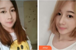 中南大學(xué)湘雅醫(yī)院整形美容中心祁敏整形價格表附清潔祛痘案例展示