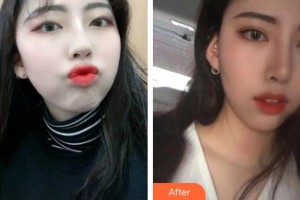 榮成眼科醫(yī)院宋旭東整形價格表附切開雙眼皮案例展示