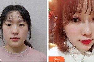 榮成眼科醫(yī)院姚佩君整形價格表附切開雙眼皮案例展示