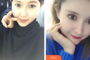 榮成眼科醫(yī)院楊華強整形價格表附眼部綜合案例展示