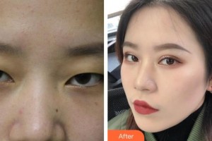 榮成眼科醫(yī)院尹彩芳整形價格表附眼部綜合案例展示