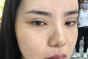 萬家燕王珍祥做下頜角怎么樣截的多嗎？附案例分享+較新價格表