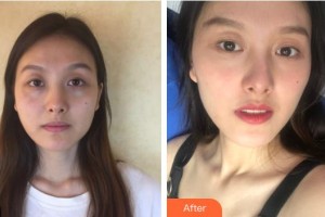 惠陽人民醫(yī)院崇雅路門診部醫(yī)療美容科何麗玲整形價格表附鼻部綜合案例展示