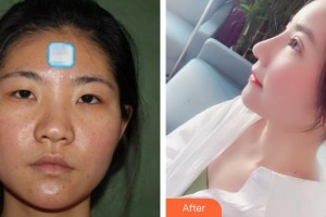 惠陽長安醫(yī)院整形美容中心陳國軍整形價格表附鼻部綜合案例展示