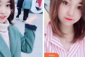 惠陽長安醫(yī)院整形美容中心鄒海昌整形價格表附耳軟骨復(fù)合隆鼻案例展示