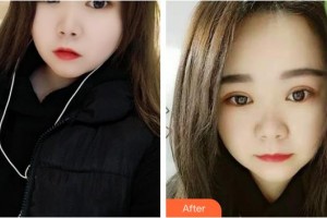 龍口光明眼科醫(yī)院張少斌整形價格表附切開雙眼皮案例展示