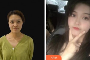 龍口光明眼科醫(yī)院梁學民整形價格表附眼部綜合案例展示