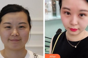 龍口光明眼科醫(yī)院王繼兵整形價格表附眼部綜合案例展示