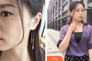 龍口光明眼科醫(yī)院李超英整形價格表附激光去黑眼圈案例展示