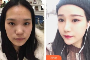 龍口光明眼科醫(yī)院曲海燕整形價格表附眼部綜合案例展示