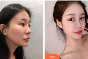 龍口光明眼科醫(yī)院胡聰整形價格表附眼部綜合案例展示