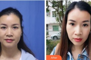 鹿邑眼科醫(yī)院劉志才整形價格表附激光去黑眼圈案例展示