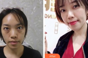 濟(jì)源林華醫(yī)療美容門診部李方整形價格表附眼部綜合案例展示