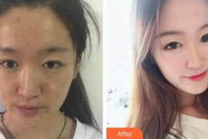 濟(jì)源林華醫(yī)療美容門診部王濤澎整形價格表附激光去眼袋案例展示