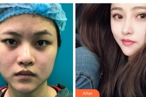 濟(jì)源尖峰眼科醫(yī)院張建平整形價格表附切開雙眼皮案例展示