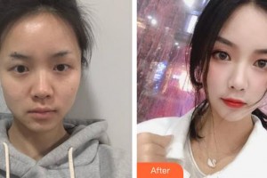 濟(jì)源尖峰眼科醫(yī)院張磊整形價格表附開內(nèi)眼角案例展示