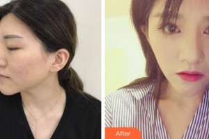 濟(jì)源尖峰眼科醫(yī)院賈劉才整形價格表附切開雙眼皮案例展示