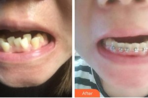 濟(jì)源向日葵口腔門診部李斌整形價格表附金屬托槽矯正案例展示