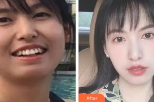 濟(jì)源霍氏口腔醫(yī)院霍文靜整形價格表附美白貼片案例展示