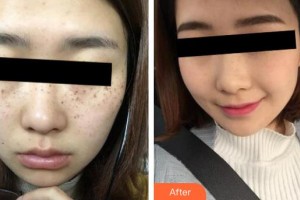 大理漾濞縣人民醫(yī)院整形美容科關(guān)志江整形價(jià)格表附激光祛斑案例展示