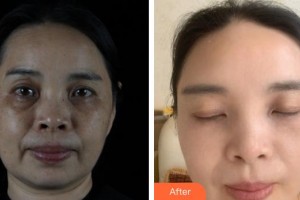 大理韓美醫(yī)療美容醫(yī)院劉隆才整形價(jià)格表附激光祛斑案例展示