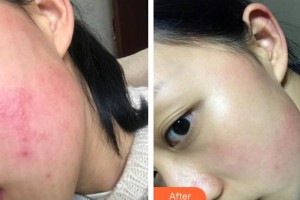 大理市第一人民醫(yī)院美容皮膚科洪春梅整形價(jià)格表附光子嫩膚案例展示