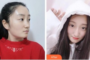 唐河?xùn)|方眼科醫(yī)院袁育新整形價格表附眼部綜合案例展示