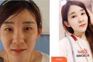 唐河?xùn)|方眼科醫(yī)院賈志軍整形價格表附眼部綜合案例展示