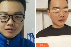 唐河?xùn)|方眼科醫(yī)院袁獻(xiàn)華整形價格表附眼部綜合案例展示