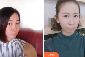 唐河?xùn)|方眼科醫(yī)院白珣整形價格表附切開雙眼皮案例展示