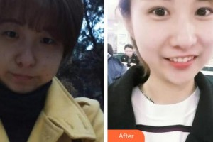 郯城新益民眼科醫(yī)院田作龍整形價格表附眼部綜合案例展示