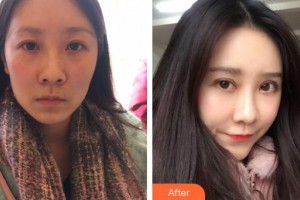 郯城新益民眼科醫(yī)院王濤整形價格表附切開雙眼皮案例展示