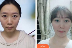 郯城新益民眼科醫(yī)院孫鼎整形價格表附上眼瞼去脂案例展示