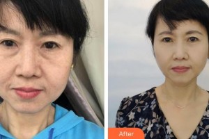 郯城縣第一人民醫(yī)院眼科孫虹整形價格表附外切祛眼袋案例展示