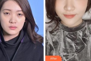 郯城新益民眼科醫(yī)院解孝峰整形價格表附切開雙眼皮案例展示