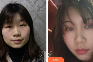 邯鄲華美醫(yī)療美容醫(yī)院王珊青整形價格表附眼部綜合案例展示