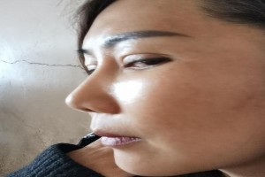 韓國(guó)一見Izien整形外科醫(yī)院金一秀輪廓修復(fù)整形果分享