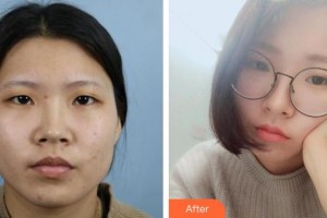 邯鄲中信皮膚科門診部韓振濤整形價(jià)格表附切開雙眼皮案例展示