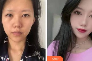 邯鄲金皇后醫(yī)療美容診所張愛花整形價(jià)格表附眼部綜合案例展示