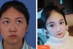 邯鄲市眼科醫(yī)院任芬花整形價(jià)格表附切開雙眼皮案例展示