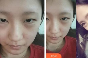 邯鄲市眼科醫(yī)院劉鐵英整形價(jià)格表附切開雙眼皮案例展示