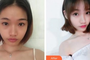 邯鄲市眼科醫(yī)院趙志強(qiáng)整形價(jià)格表附眼部綜合案例展示