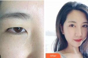 邯鄲市眼科醫(yī)院袁瑞芝整形價(jià)格表附眼部綜合案例展示