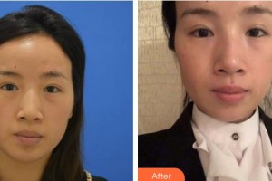 邯鄲市眼科醫(yī)院呂靖整形價格表附激光去眼袋案例展示