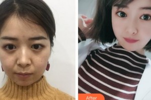 邯鄲愛(ài)眼眼科醫(yī)院高占國(guó)整形價(jià)格表附切開(kāi)雙眼皮案例展示