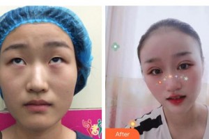 邯鄲愛爾眼科醫(yī)院孫蘭萍院長整形價格表附切開雙眼皮案例展示