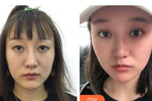 邯鄲愛(ài)爾眼科醫(yī)院陳龍整形價(jià)格表附眼部修復(fù)案例展示